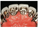 implante dentare