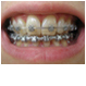 implante dentare