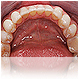implante dentare
