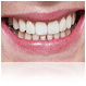 implante dentare
