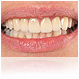 implante dentare