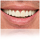 implante dentare