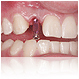 implante dentare