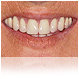 implante dentare